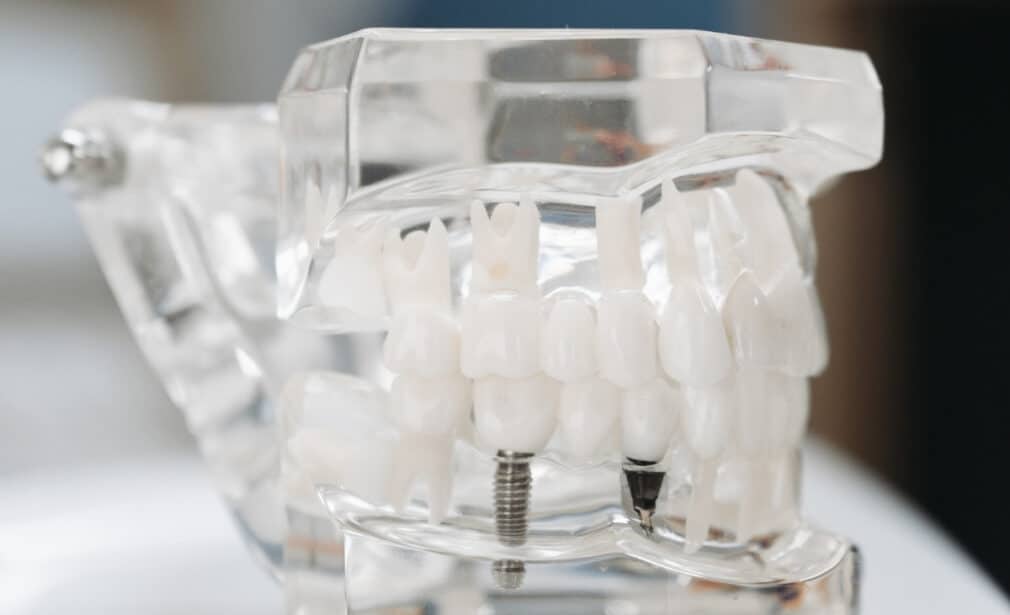 implant tedavisi