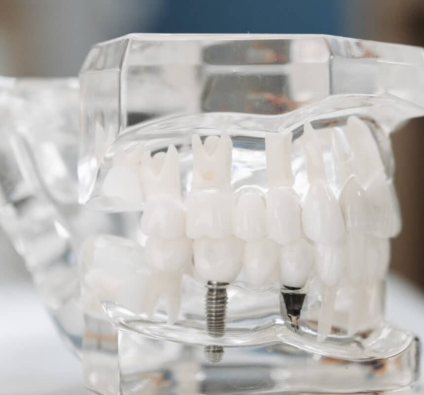 implant tedavisi