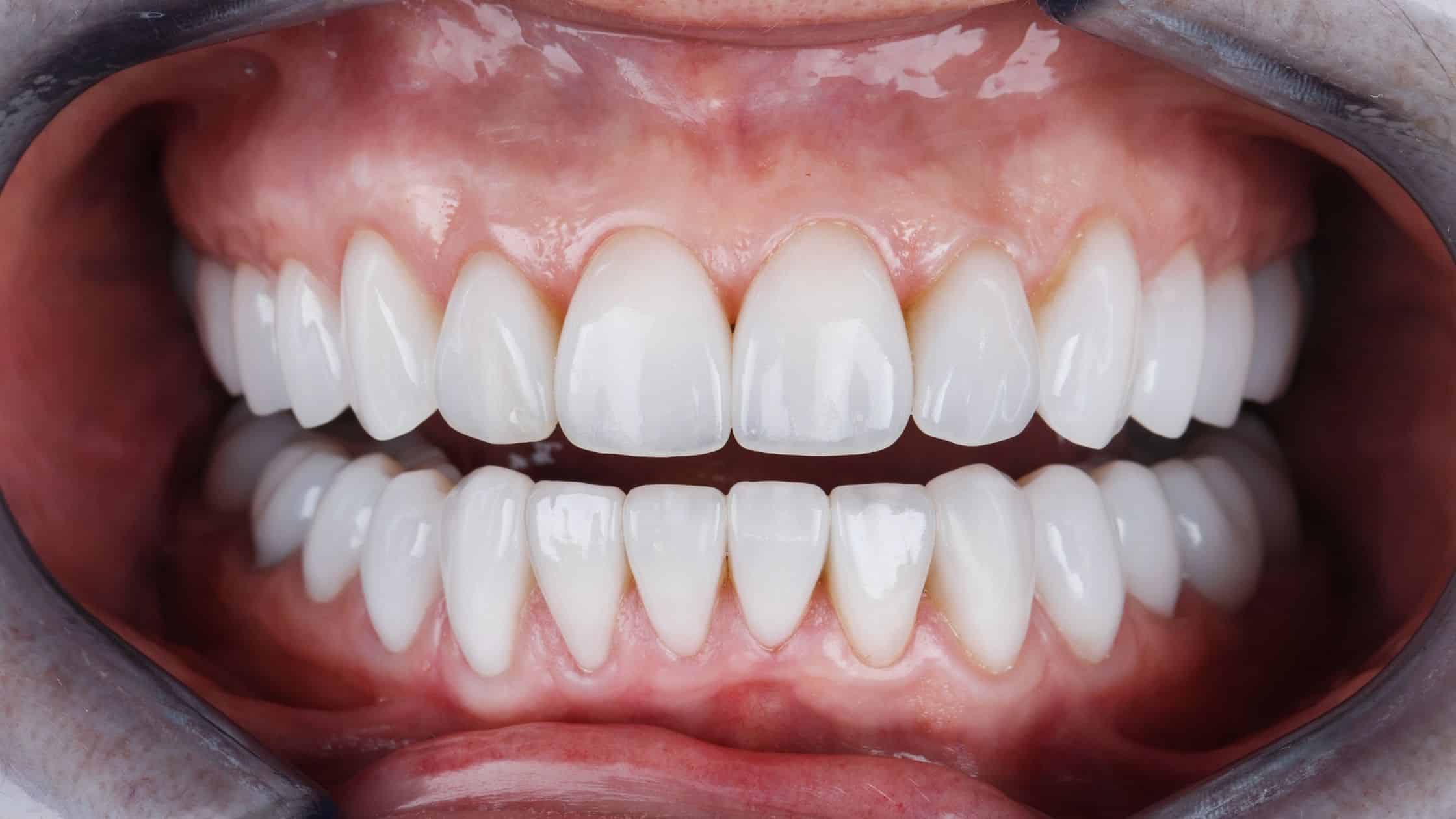 lamina veneer uygulanmış diş
