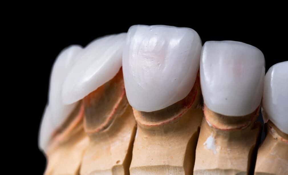 lamina veneer