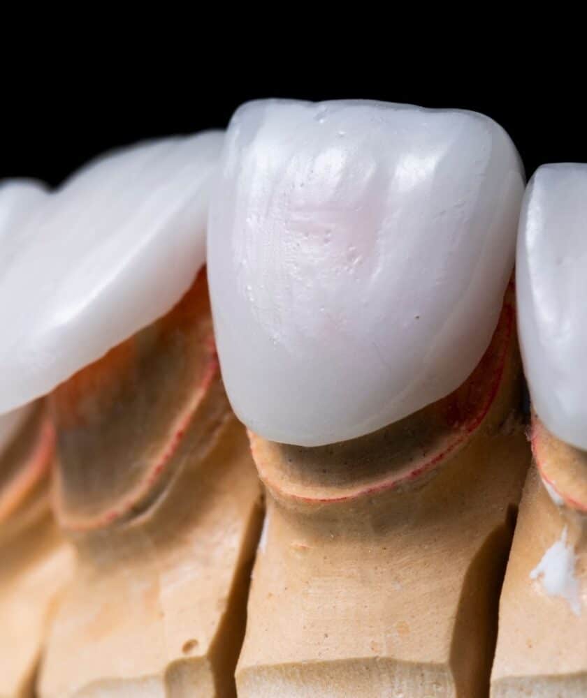lamina veneer