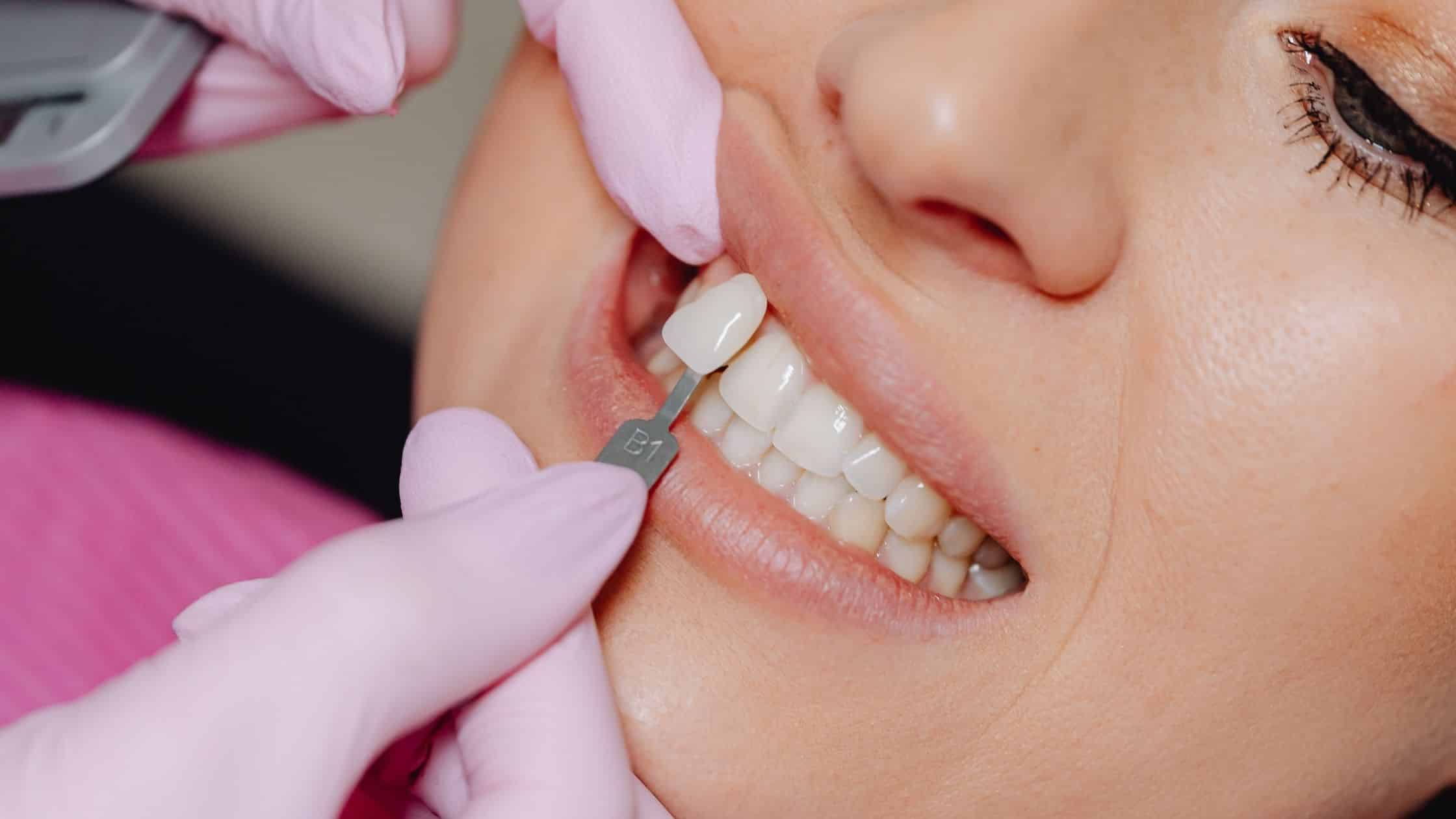 lamina veneer ölçüsü alınan bir kadın