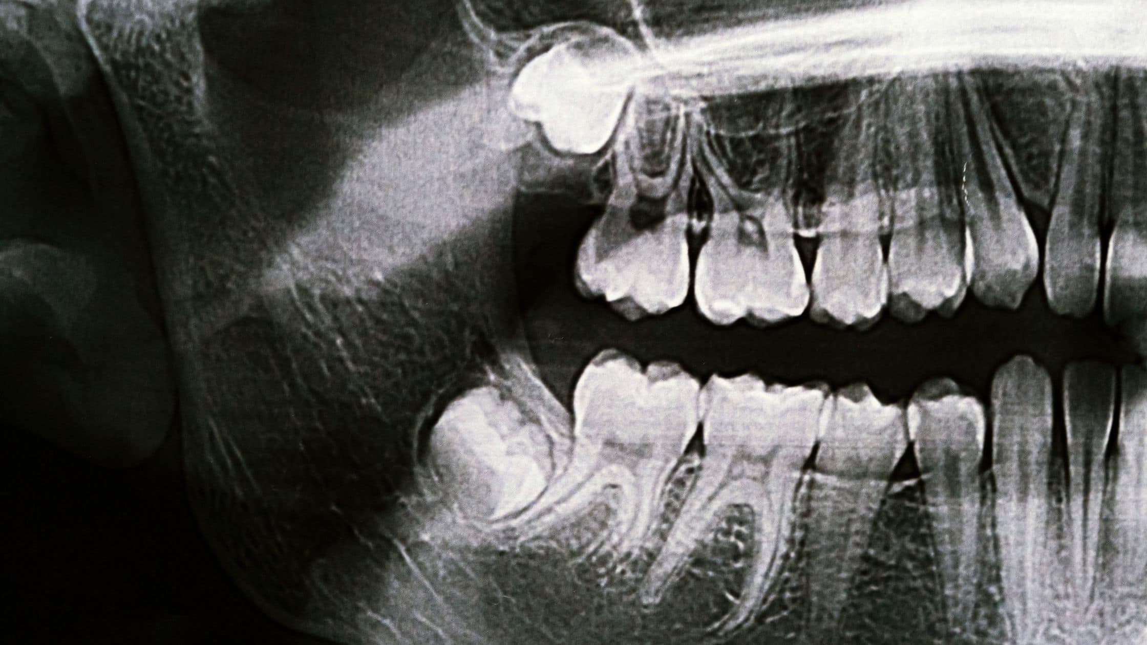xray gömülü diş görüntüsü