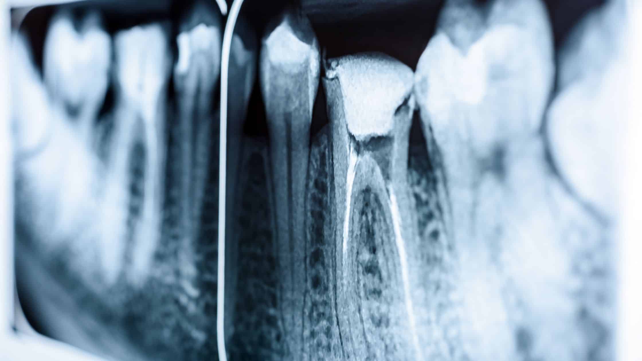 endodonti tedavisi için dişlerin röntgen görüntüsü