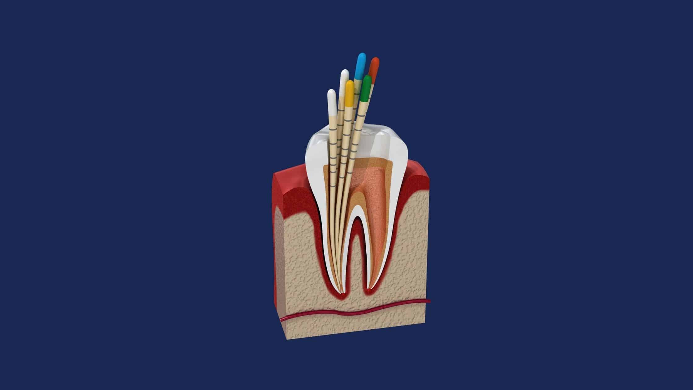 endodonti