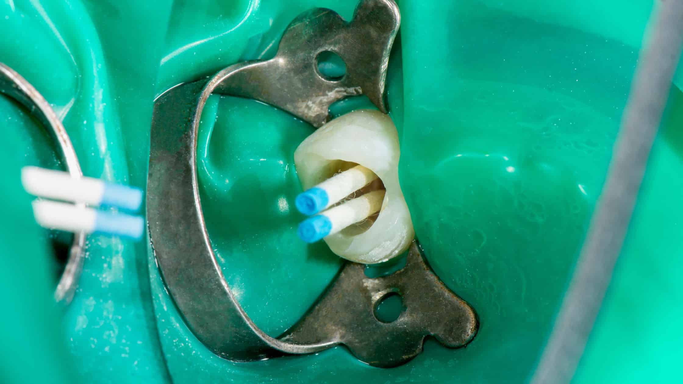 endodonti tedavisinde diş köklerinin dolgulanması