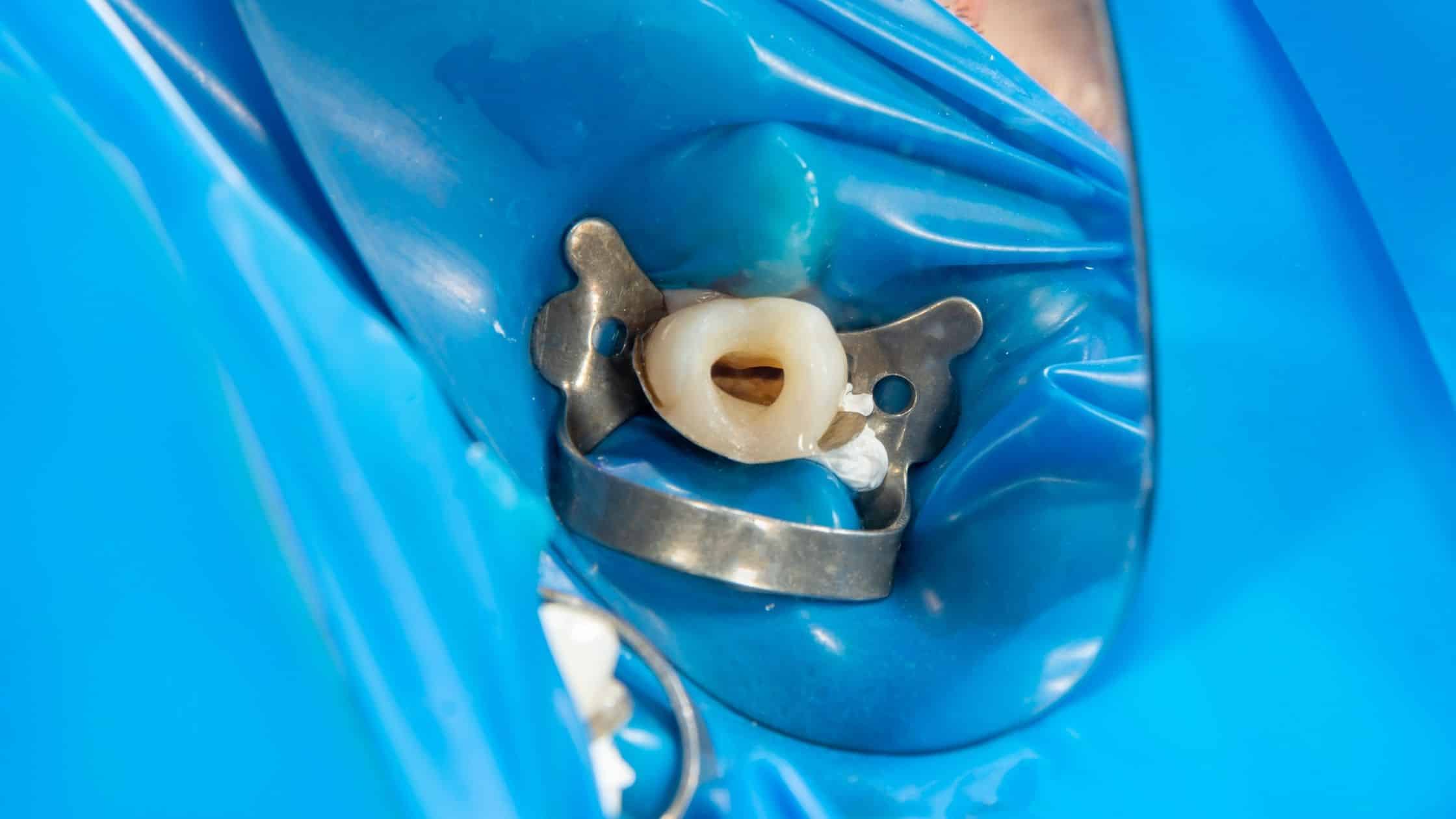 endodonti tedavisinde diş köklerinin temizlenmesi