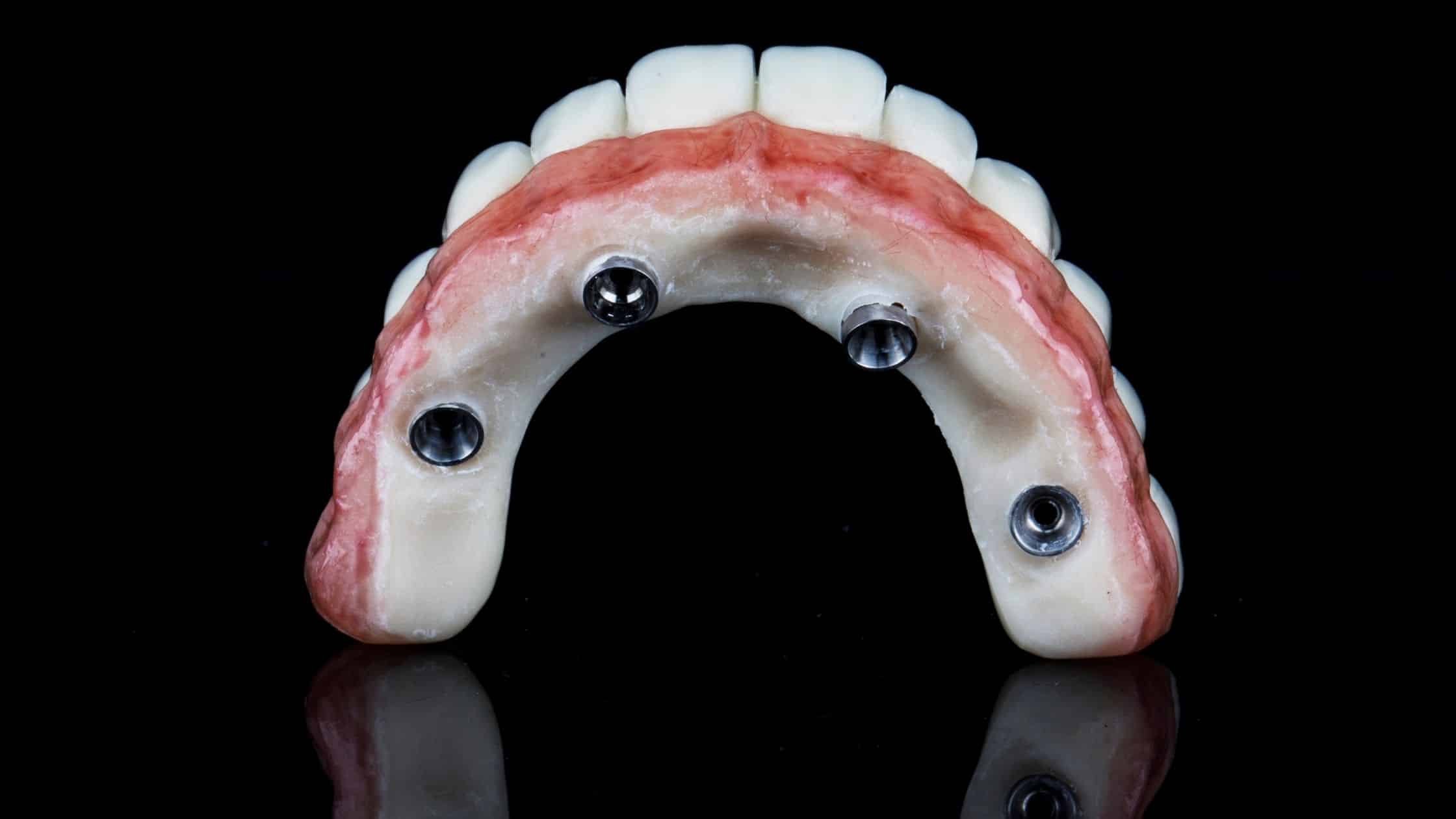 protetik diş tedavisinde implant üstü protez