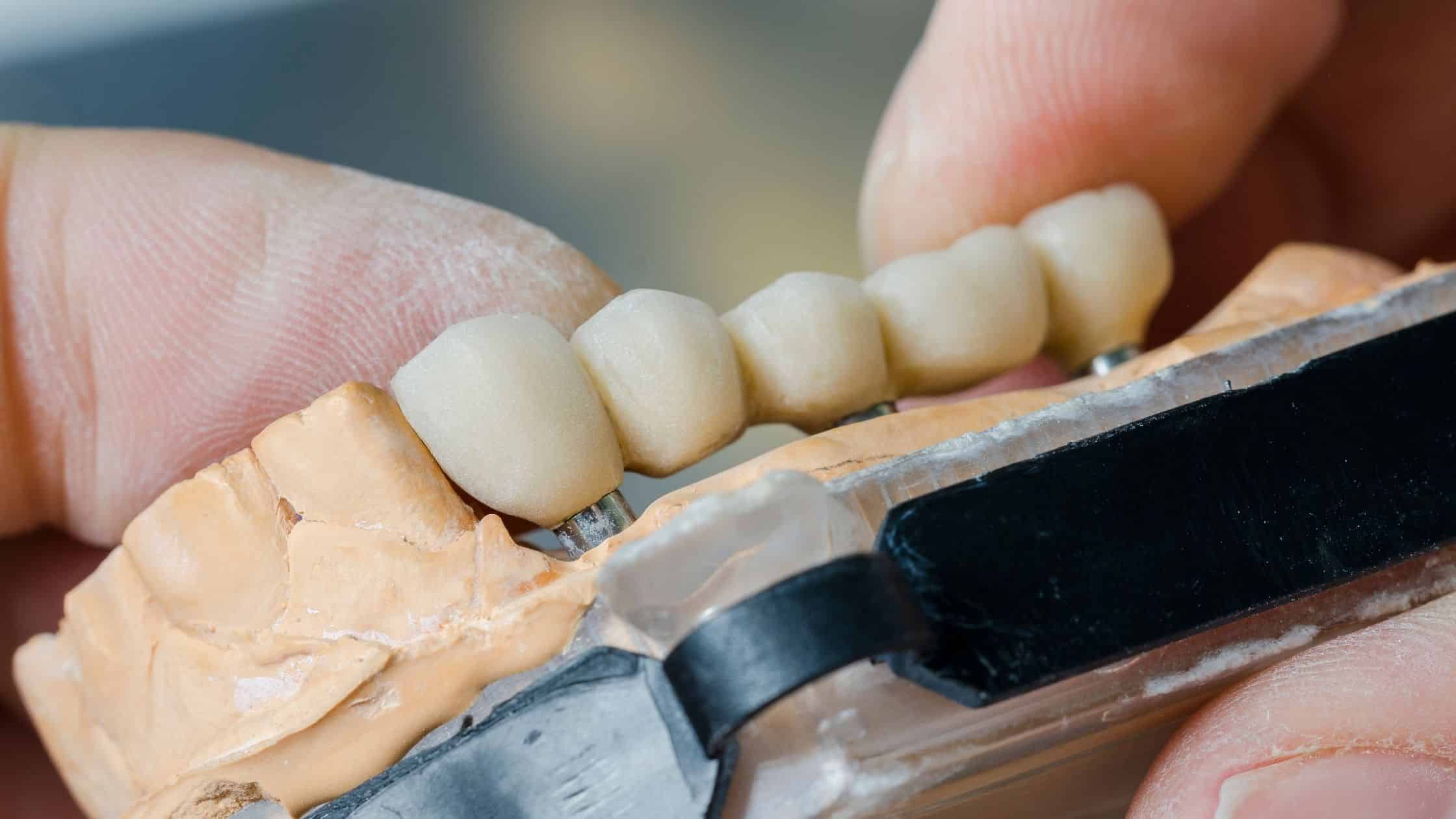 protetik diş tedavisinde sabit diş protezi