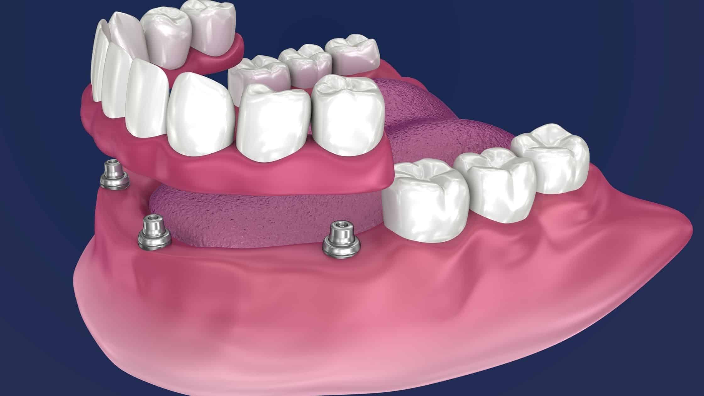 protez diş türlerinden implant üstü protezler