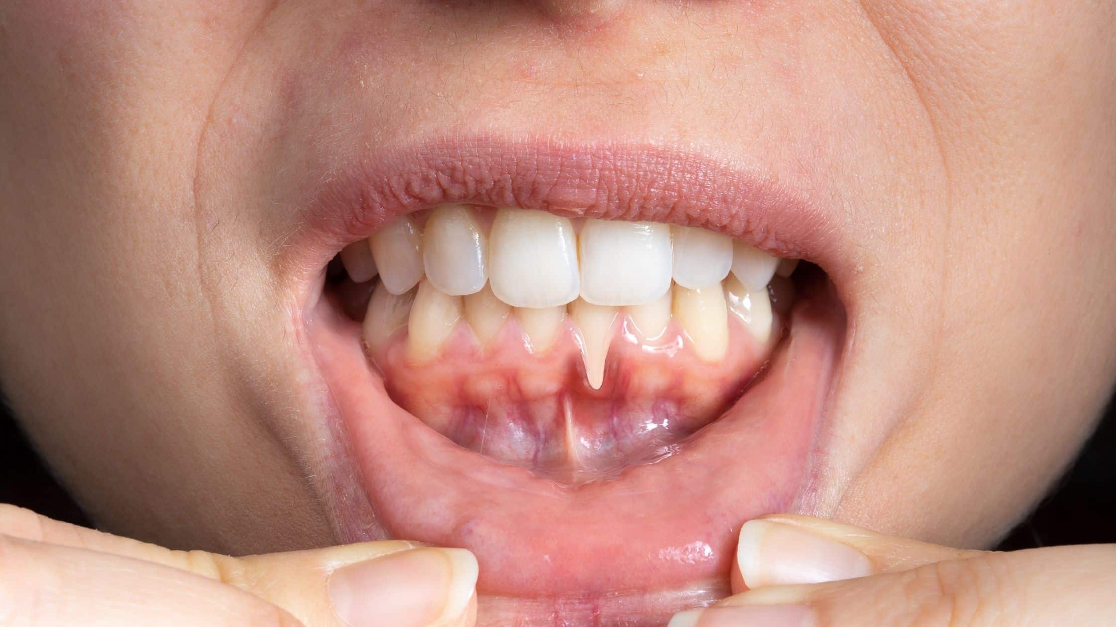 diş eti çekilmesi periodontitis