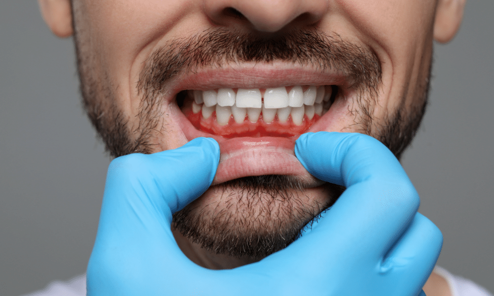diş eti iltihabı gingivitis